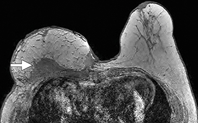 Seroma in a 60-year-old woman with pain and increased volume in the right breast